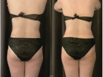 リノリー(rinory)/脂肪冷却痩身