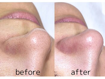 フラックス 京都(FLUX)/【エンビロン】黒詰毛穴コース