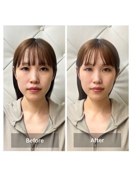 ヴィーライン 恵比寿本院(VeLine)/お客様Before After/小顔効果