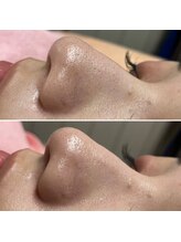 ララ(LALA)/【姪浜・室見・藤崎】毛穴洗浄