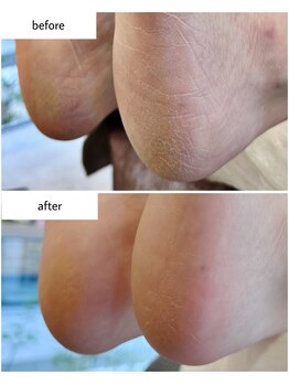 ケアプラス(care plus)/足裏角質ケア