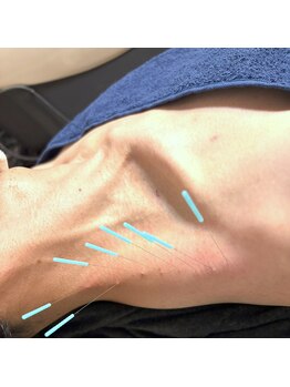 とだ鍼灸院/《鍼灸施術》首肩レスキュー鍼灸