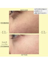 ジルフィー(GILFY)/毛穴/シワ/シミ/くすみのお悩み