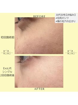 ジルフィー(GILFY)/毛穴/シワ/シミ/くすみのお悩み