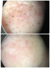 にじいろ美容整体/毛穴汚れが！