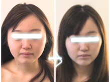 シエル(Ciel)の雰囲気（小顔矯正コルギ3回の結果です）