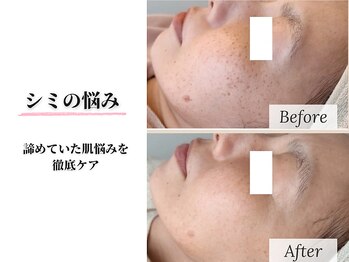 リシェス(Richesse)/シミが改善！透明感のある肌へ