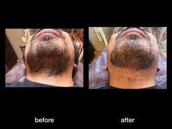 トゥルース(Truth)/美容電気脱毛で終わりある脱毛