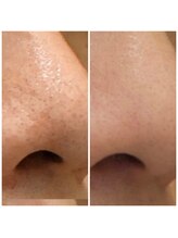 ダリア(DALIA)/エンビロンで毛穴ケア♪