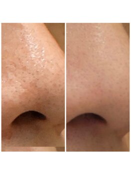 ダリア(DALIA)/エンビロンで毛穴ケア♪