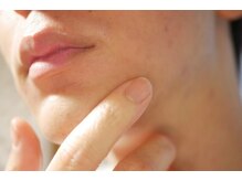 ビューティサロン ココモ(Cocomo)の雰囲気（髭剃り軽減/清潔感UP/抜けにくい男性髭に特化した脱毛機完備）