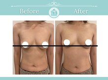 美人バスト 赤羽店/【バストアップ★育乳】症例