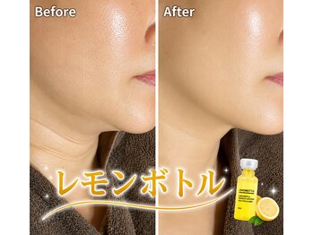 ミール(Meel)の写真/もたつくフェイスラインやエラ張りをキュッ!スッキリ引き締め!お顔のむくみの大掃除で写真映りも◎