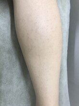 ナノハナ/鹿沼市本格全身脱毛ナノハナ