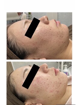 チャマ 高知店(CHAMA)/20代 ニキビ 赤み 毛穴