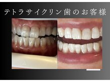 エランホワイトニング 一社店/症例写真