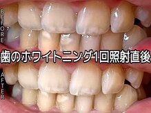 ヴィオール 名古屋栄店(VIOR)/白くしながら歯質強化！