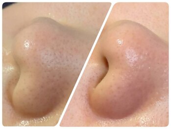 トータルビューティ ノイド(Noid)/毛穴洗浄　小鼻のみ