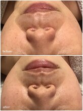 アミィ(amii)/肌育ボンバーフェイシャル