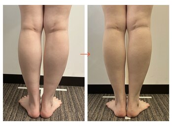 ハリヒト アランカール 仙台(HALicht Alankar)/美脚整体4回ビフォーアフター