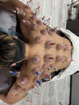 シャイン鍼灸整骨院 粉浜院/吸い玉