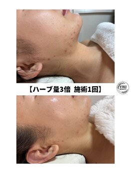 ヴィキ 北千住(VIKI)/【ハーブ量3倍　施術1回】