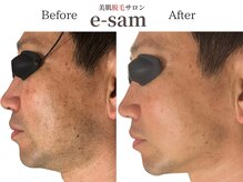 イーサム 高槻摂津富田店(e-sam)/髭脱毛