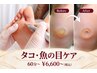 【足裏ケアのプロ】タコ＋うおのめケア60分～90分￥6600～￥9900(初見料+550円)