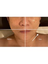 アリュール(Allure)/フェイシャル引き上げ