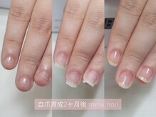 ミンスネイル(Mins Nail)/深爪矯正before&after