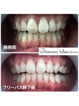 ホワイトニングサロン 京都烏丸店/ホワイトニング施術例