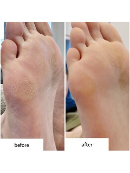 ケアプラス(care plus)/足裏角質ケア