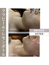 肌イズム つくば店(肌ism)/【before&after】韓国小顔セット