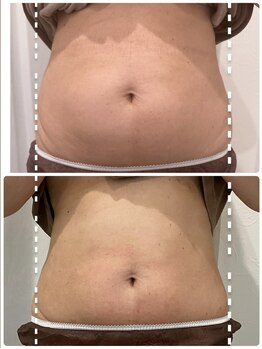 リノア(LINORE)/脂肪分解剤6回