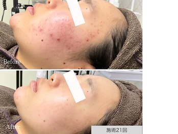 ニキビ研究所 千葉店/お顔全体のニキビケア
