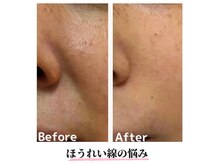 リシェス(Richesse)/長年のほうれい線の悩みが改善！