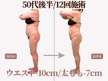 ベモーレ 谷町九丁目 上本町/50代後半/12回施術