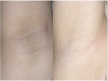 エピア 西尾店(Epia)/【脱毛】脇