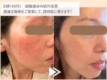 レイテノール 藤沢店/超敏感肌さんの肌改善