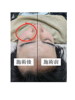 ティンクル サロン(Twinkle salon)/顔全体脱毛