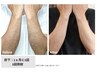 【男性限定】海・プール行く前に！！うで全体脱毛で清潔感UP！初回￥5000
