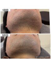 アイアイくらぶ美容部/ひげ脱毛