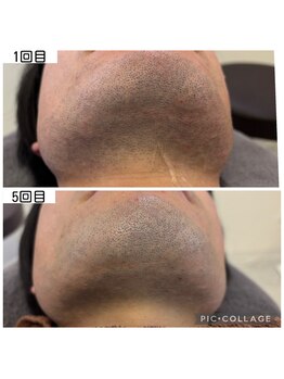 アイアイくらぶ美容部/ひげ脱毛