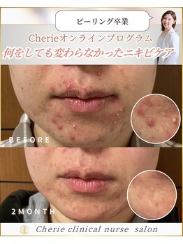 シェリー(Cherie)/施術なし！長年悩むニキビケア