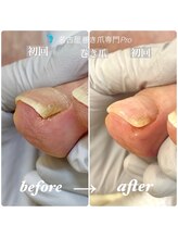 名古屋巻き爪専門Pro/なぜたまに爪が痛くなるのか？