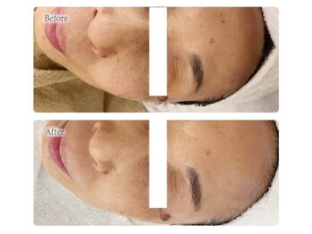 オービーエム 博多阪急店(O.B.M)/【50代シミケア症例】