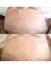 ララリア(LaLaLia)/フェイスWAX脱毛