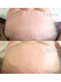 ララリア(LaLaLia)/フェイスWAX脱毛