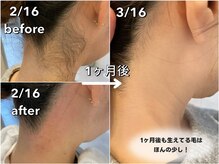 サロンネム(Salon Nem)/うなじW脱毛