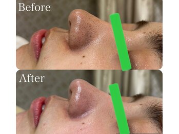 マーレン(Malen)/【クリスティーナ症例写真】